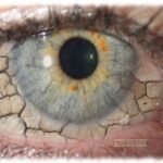 How to Cure Dry Eyes Permanently